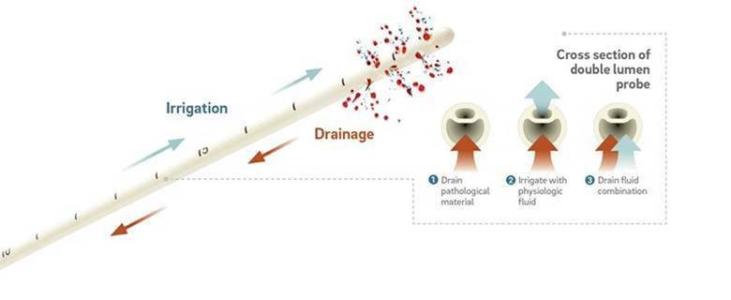 IRRAflow Catheter Probe: Illustrating its unique Active Fluid Exchange mechanism of action, as well as a cross-sectional image showing its dual-lumen functionality. 
