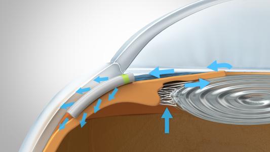 Belgian med-tech innovator iSTAR Medical secures €20 million European financing from the EIB