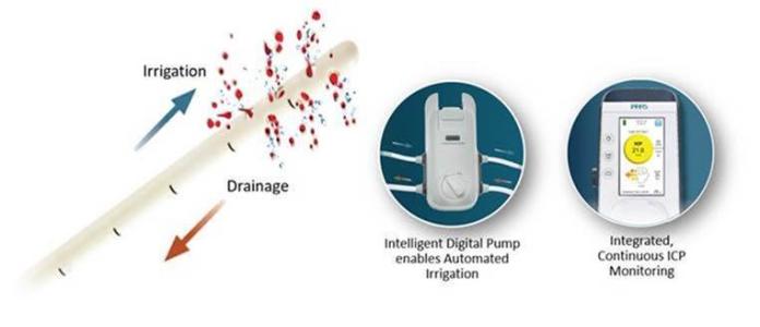 IRRAflow:The world’s first irrigating intracranial drainage system