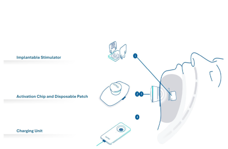 Belgian medtech Nyxoah secures €37.5 million EIB venture-debt financing to treat obstructive sleep apnea 