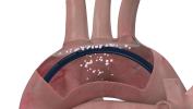 Medtech Protembis gets €20 million EIB backing for technology to protect brain during heart treatment